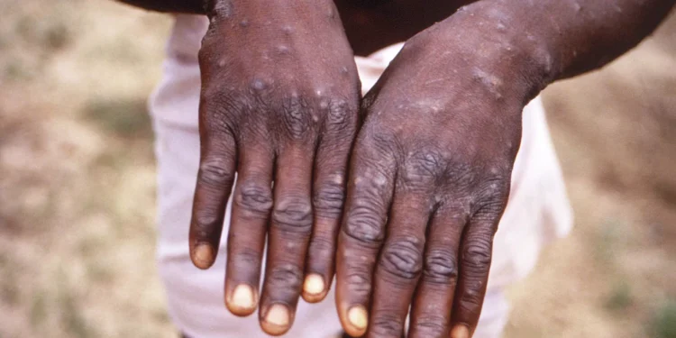 Mpox Outbreak in Republic of the Congo: Nineteen Cases Confirmed