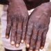 Mpox Outbreak in Republic of the Congo: Nineteen Cases Confirmed